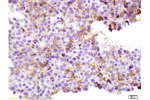 Formalin-fixed and paraffin embedded rat melanoma labeled with Anti-SPANX Polyclonal Antibody, Unconjugated (ABIN721675) at 1:200 followed by conjugation to the secondary antibody and DAB staining.