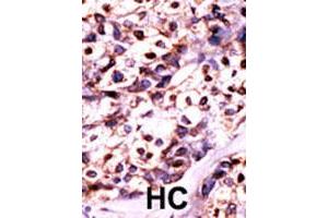 Formalin-fixed and paraffin-embedded human cancer tissue reacted with UCK2 polyclonal antibody  , which was peroxidase-conjugated to the secondary antibody, followed by DAB staining. (UCK2 antibody  (N-Term))
