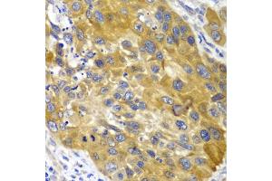 Immunohistochemistry of paraffin-embedded human esophageal cancer using AK1 antibody. (Adenylate Kinase 1 antibody)