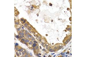 Immunohistochemistry of paraffin-embedded human stomach cancer using GYS1 antibody.