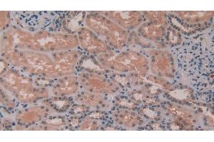 Immunohistochemistry (IHC) image for anti-Matrix Metallopeptidase 11 (Stromelysin 3) (MMP11) (AA 277-488) antibody (ABIN7431380)