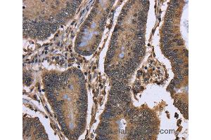 Immunohistochemistry of Human colon cancer using DCP1A Polyclonal Antibody at dilution of 1:50 (DCP1A antibody)