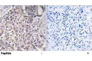 Immunohistochemistry analysis of paraffin-embedded human liver carcinoma tissue using CYP4F2 polyclonal antibody .
