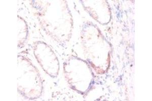 Immunohistochemistry of paraffin-embedded human colon cancer using ABIN7153948 at dilution of 1:50 (PSMA antibody  (AA 48-750))