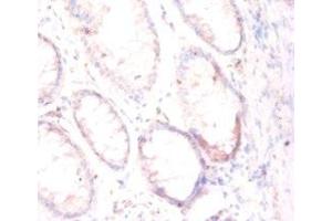Immunohistochemistry of paraffin-embedded human colon cancer using ABIN7153948 at dilution of 1:50 (PSMA antibody  (AA 48-750))