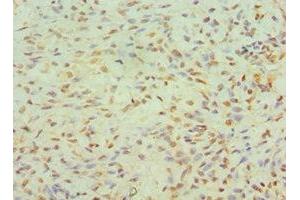 Immunohistochemistry of paraffin-embedded human breast cancer using ABIN7145557 at dilution of 1:100 (JMJD6 antibody  (AA 1-320))