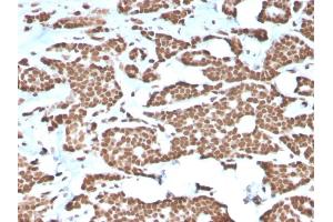 Formalin-fixed, paraffin-embedded human Breast Carcinoma stained with Histone H1 Rabbit Recombinant Monoclonal Antibody (AE-4). (Recombinant Histone H1 antibody)