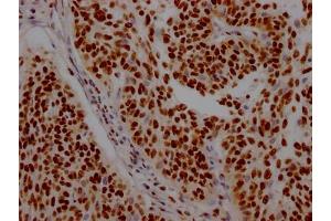 IHC image of ABIN7127571 diluted at 1:100 and staining in paraffin-embedded human cervical cancer performed on a Leica BondTM system. (Recombinant Interleukin enhancer-binding factor 3 (ILF3) antibody)