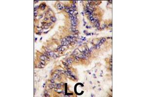 Formalin-fixed and paraffin-embedded human lung carcinoma tissue reacted with TRAPPC4 polyclonal antibody  , which was peroxidase-conjugated to the secondary antibody, followed by DAB staining. (TRAPPC4 antibody  (N-Term))