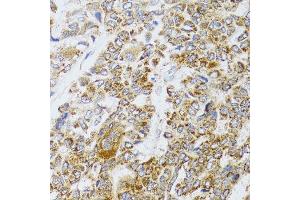 Immunohistochemistry of paraffin-embedded human liver cancer using AIFM3 antibody (ABIN5996156) at dilution of 1/100 (40x lens). (AIFM3 antibody)