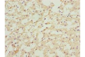 Immunohistochemistry of paraffin-embedded human liver cancer using ABIN7144572 at dilution of 1:100 (ASAP3 antibody  (AA 451-700))