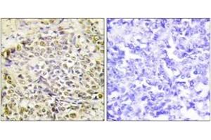Immunohistochemistry analysis of paraffin-embedded human lung carcinoma tissue, using IRX2 Antibody. (IRX2 antibody  (AA 231-280))