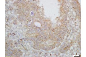 Formalin-fixed and paraffin embedded human gastric carcinoma labeled with Rabbit Anti-ARPC2/p34-ARC Polyclonal Antibody, Unconjugated  at 1:200 followed by conjugation to the secondary antibody and DAB staining