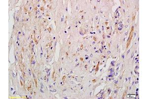 Formalin-fixed and paraffin embedded human pneumonic lung tissue labeled with Anti-EDG4/LPA2 Polyclonal Antibody, Unconjugated (ABIN681118) at 1:200 followed by conjugation to the secondary antibody and DAB staining (Angiotensin II Type-1 Receptor antibody)