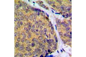 Immunohistochemical analysis of MKK2 (pT394) staining in human breast cancer formalin fixed paraffin embedded tissue section. (MEK2 antibody  (C-Term, pSer394))