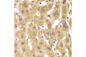 Immunohistochemistry of paraffin-embedded human liver damage using Slug Antibody (ABIN6127298, ABIN6148181, ABIN6148183 and ABIN6217314) at dilution of 1:100 (40x lens). (SLUG antibody  (AA 126-268))