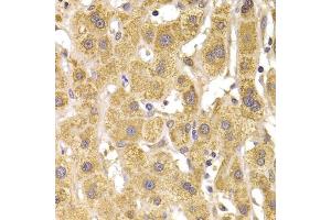 Immunohistochemistry of paraffin-embedded human liver damage using Slug Antibody (ABIN6127298, ABIN6148181, ABIN6148183 and ABIN6217314) at dilution of 1:100 (40x lens).