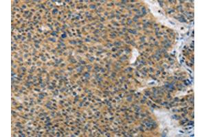 The image on the left is immunohistochemistry of paraffin-embedded Human liver cancer tissue using ABIN7128398(ANAPC13 Antibody) at dilution 1/25, on the right is treated with fusion protein. (ANAPC13 antibody)