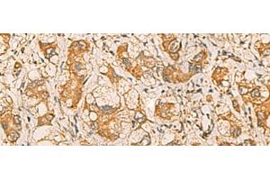 Immunohistochemistry of paraffin-embedded Human liver cancer tissue using MRPL9 Polyclonal Antibody at dilution of 1:55(x200)