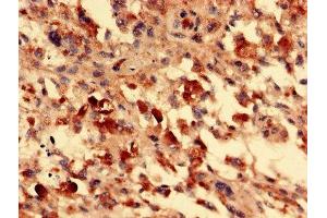 Immunohistochemistry analysis of human melanoma using ABIN7153105 at dilution of 1:100 (FOXR2 antibody  (AA 1-300))
