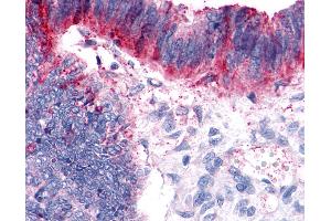 Anti-GPER1 / GPR30 antibody IHC of human Colon, Carcinoma. (GPER antibody  (Extracellular Domain))