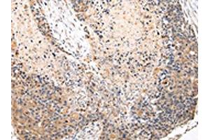 The image on the left is immunohistochemistry of paraffin-embedded Human esophagus cancer tissue using ABIN7131583(VPS37A Antibody) at dilution 1/20, on the right is treated with fusion protein. (VPS37A antibody)