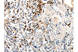 The image on the left is immunohistochemistry of paraffin-embedded Human gastric cancer tissue using ABIN7190149(CD93 Antibody) at dilution 1/60, on the right is treated with synthetic peptide.