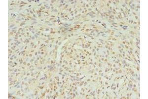 Immunohistochemistry of paraffin-embedded human breast cancer using ABIN7169003 at dilution of 1:100 (STK38L antibody  (AA 212-464))