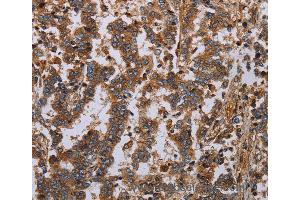 Immunohistochemistry of Human liver cancer using GDF2 Polyclonal Antibody at dilution of 1:40 (GDF2 antibody)