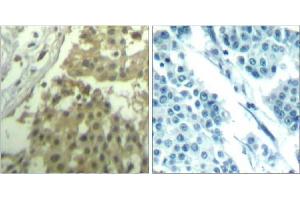 Immunohistochemical analysis of paraffin-embedded human breast carcinoma tissue using cdc2 (Ab-19) Antibody (E021529). (CDK1 antibody)