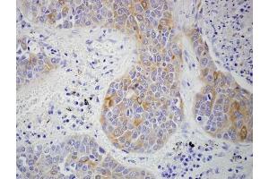 Human lung cancer (formalin-fixed, paraffin embedded) stained with human lumican antibody. (LUM antibody  (AA 211-227))