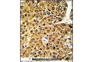 Formalin-fixed and paraffin-embedded human hepatocarcinoma with MLX Antibody (Center), which was peroxidase-conjugated to the secondary antibody, followed by DAB staining. (MLX antibody  (AA 125-151))