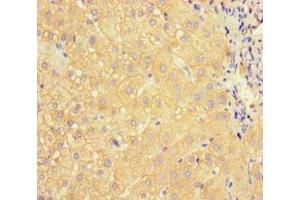Immunohistochemistry of paraffin-embedded human liver cancer using ABIN7144419 at dilution of 1:100 (APOC3 antibody  (AA 21-99))