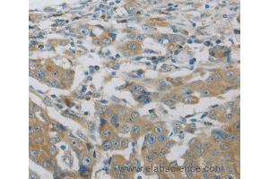 Immunohistochemistry of Human breast cancer using MAP2K6 Polyclonal Antibody at dilution of 1:30 (MAP2K6 antibody)