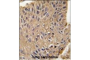 Formalin-fixed and paraffin-embedded human lung carcinoma tissue reacted with ANTXR1 Antibody  (ABIN392154 and ABIN2841879) , which was peroxidase-conjugated to the secondary antibody, followed by DAB staining. (ANTXR1 antibody  (AA 358-386))