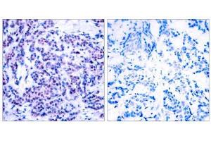 Immunohistochemical analysis of paraffin-embedded human breast carcinoma tissue using JunD (phospho- Ser255) antibody (E011028). (JunD antibody  (pSer255))