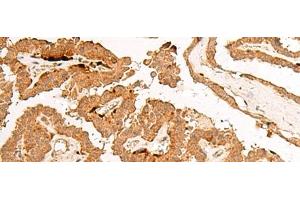 Immunohistochemistry of paraffin-embedded Human thyroid cancer tissue using POLR2L Polyclonal Antibody at dilution of 1:45(x200) (POLR2L antibody)