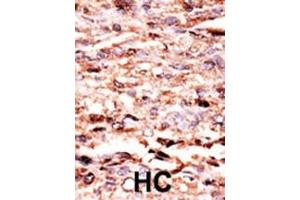 Formalin-fixed and paraffin-embedded human cancer tissue reacted with the primary antibody, which was peroxidase-conjugated to the secondary antibody, followed by AEC staining. (C-JUN antibody  (pSer63))