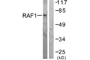Immunohistochemistry analysis of paraffin-embedded human lung carcinoma tissue using Raf1 (Ab-621) antibody.