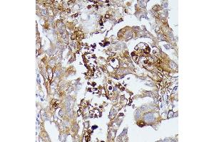 Immunohistochemistry of paraffin-embedded human lung cancer using CD52 antibody (ABIN7266207) at dilution of 1:100 (40x lens). (CD52 antibody  (AA 1-61))
