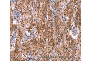 Immunohistochemistry of Human gastric cancer using GH1 Polyclonal Antibody at dilution of 1:40 (Growth Hormone 1 antibody)
