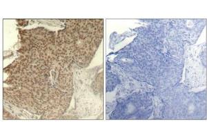 Immunohistochemical analysis of paraffin-embedded human breast carcinoma tissue using HDAC2(Phospho-Ser394) Antibody(left) or the same antibody preincubated with blocking peptide(right). (HDAC2 antibody  (pSer394))