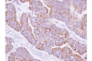 IHC-P Image Immunohistochemical analysis of paraffin-embedded human gastric cancer, using JIK, antibody at 1:100 dilution. (TAO Kinase 3 antibody)