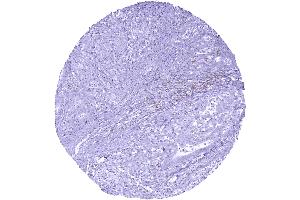 Gastric adenocarcinoma containing multiple TIGIT positive lymphocytes