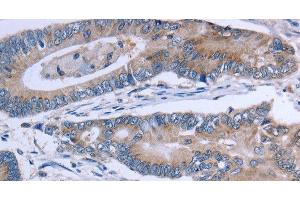 Immunohistochemistry of paraffin-embedded Human colon cancer using SLC1A6 Polyclonal Antibody at dilution of 1:40
