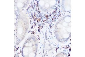 Immunohistochemistry of paraffin-embedded human colon carcinoma using Thromboxane synthase Rabbit pAb (ABIN6132172, ABIN6148915, ABIN6148917 and ABIN6219149) at dilution of 1:50 (40x lens). (TBXAS1 antibody  (AA 355-534))