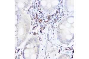 Immunohistochemistry of paraffin-embedded human colon carcinoma using Thromboxane synthase Rabbit pAb (ABIN6132172, ABIN6148915, ABIN6148917 and ABIN6219149) at dilution of 1:50 (40x lens). (TBXAS1 antibody  (AA 355-534))