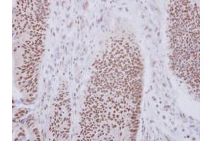 IHC-P Image Immunohistochemical analysis of paraffin-embedded human colon carcinoma, using XAB2, antibody at 1:250 dilution. (XAB2 antibody  (N-Term))
