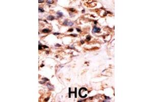 Formalin-fixed and paraffin-embedded human cancer tissue reacted with the primary antibody, which was peroxidase-conjugated to the secondary antibody, followed by DAB staining. (UCKL1 antibody  (N-Term))