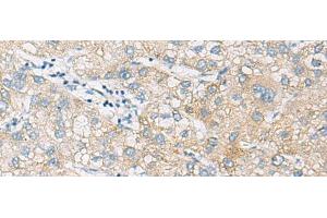 Immunohistochemistry of paraffin-embedded Human liver cancer tissue using NCOA4 Polyclonal Antibody at dilution of 1:130(x200) (NCOA4 antibody)